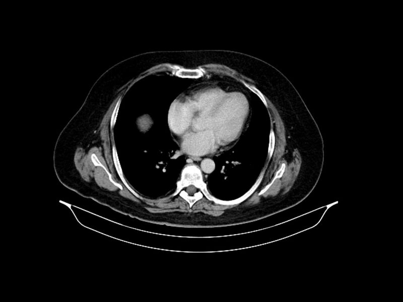 File:Adenocarcinoma of pancreas with hepatic metastasis (Radiopaedia 64332-73122 Axial C+ delayed 9).jpg