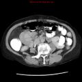 Adenocarcinoma of the colon (Radiopaedia 8191-9039 Axial renal excretory phase 25).jpg