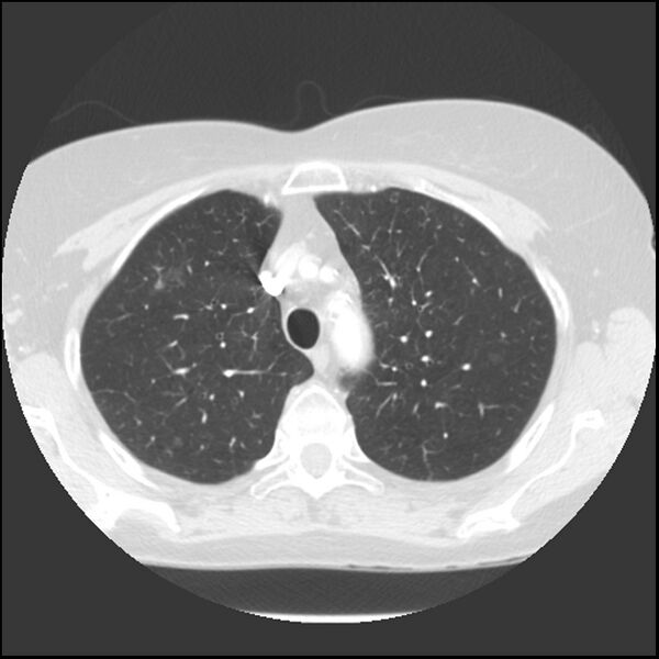File:Adenocarcinoma of the lung (Radiopaedia 41015-43755 Axial lung window 30).jpg
