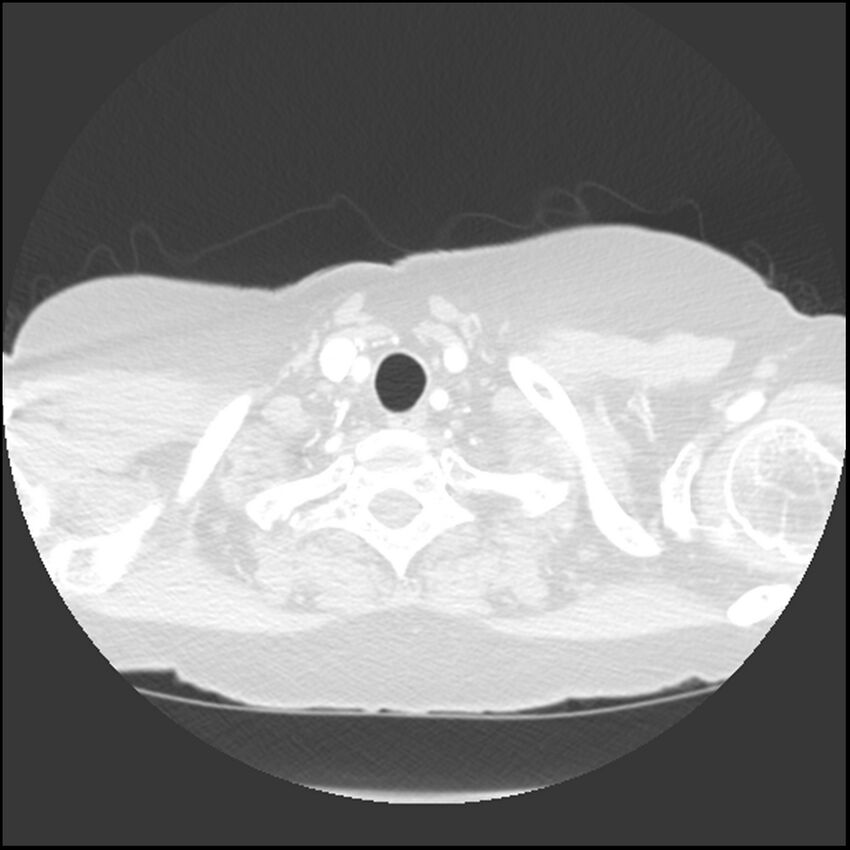 Adenocarcinoma of the lung (Radiopaedia 41015-43755 Axial lung window 6).jpg