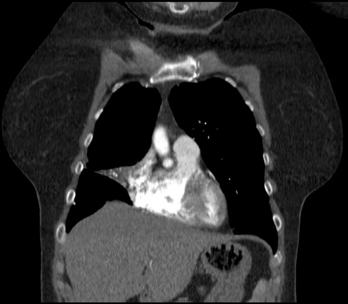 File:Adenocarcinoma of the lung (Radiopaedia 44205-47803 Coronal C+ portal venous phase 21).jpg