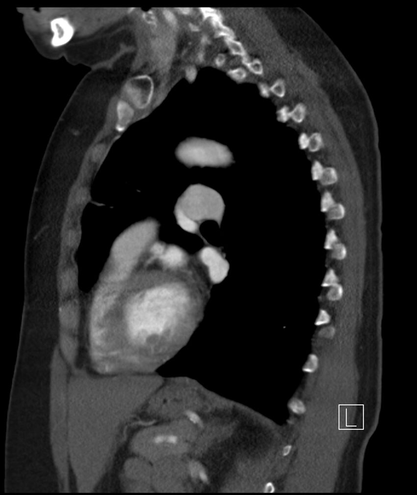 Adenocarcinoma of the lung (Radiopaedia 44205-47803 Sagittal C+ portal venous phase 23).jpg