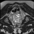 Adenoma malignum of the cervix (Radiopaedia 24460-24765 Coronal T2 22).jpg