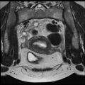 Adenoma malignum of the cervix (Radiopaedia 24460-24765 Coronal T2 7).jpg