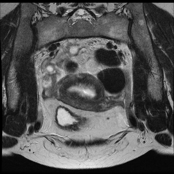 File:Adenoma malignum of the cervix (Radiopaedia 24460-24765 Coronal T2 7).jpg