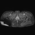 Adenomyoma of the uterus (huge) (Radiopaedia 9870-10438 Axial T1 C+ fat sat 2).jpg