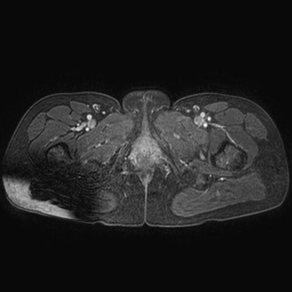 File:Adenomyoma of the uterus (huge) (Radiopaedia 9870-10438 Axial T1 C+ fat sat 2).jpg
