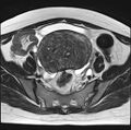Adenomyosis - ovarian endometriomas (Radiopaedia 67031-76350 Axial T2 10).jpg