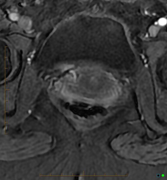 File:Adenomyosis uterus with hematometra (Radiopaedia 45779-50011 Axial T1 C+ fat sat 56).jpg