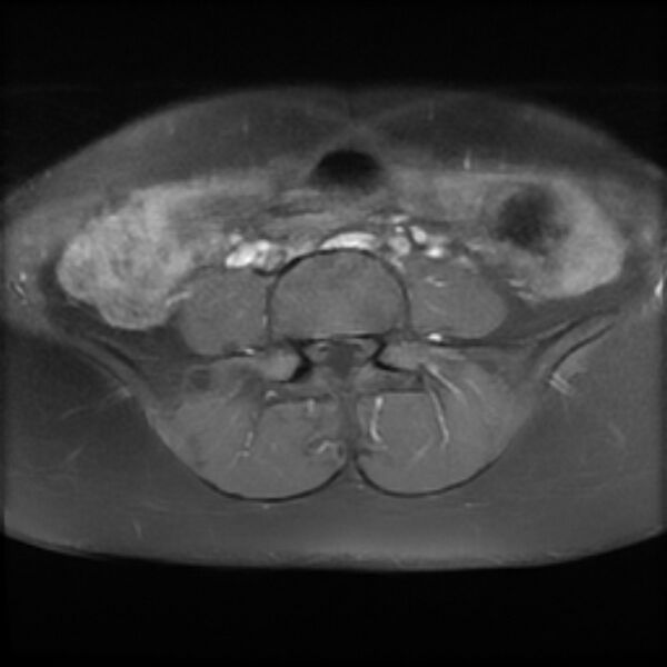 File:Adenomyosis within a septate uterus (Radiopaedia 69963-79981 Axial T1 C+ fat sat 1).jpg