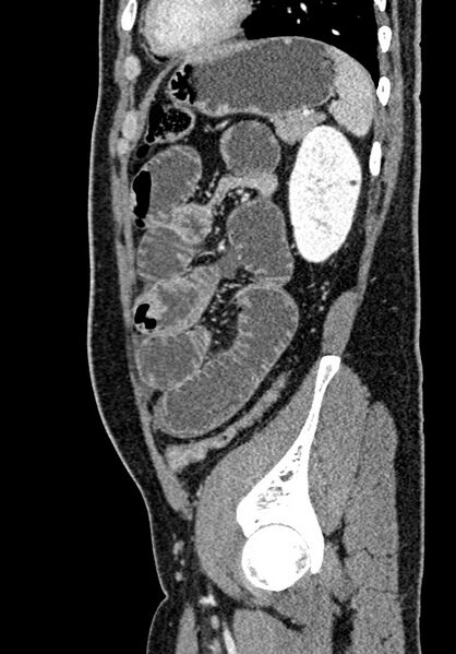 File:Adhesional small bowel obstruction (Radiopaedia 58900-66131 Sagittal C+ portal venous phase 191).jpg
