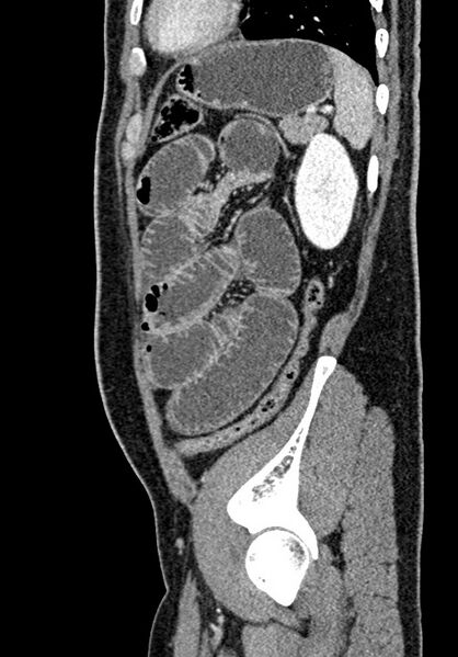 File:Adhesional small bowel obstruction (Radiopaedia 58900-66131 Sagittal C+ portal venous phase 197).jpg