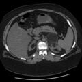 Adrenal myelolipoma (Radiopaedia 8216-9068 Axial non-contrast 16).jpg