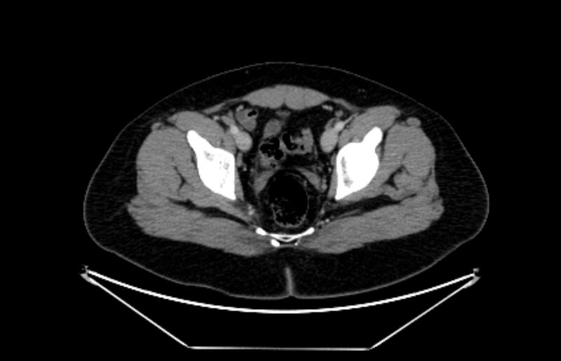 File:Adrenocortical carcinoma (Radiopaedia 80134-93438 Axial C+ portal venous phase 119).jpg