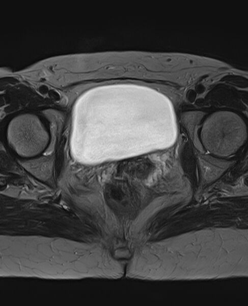 File:Adult granulosa cell tumor of the ovary (Radiopaedia 71581-81950 Axial T2 20).jpg