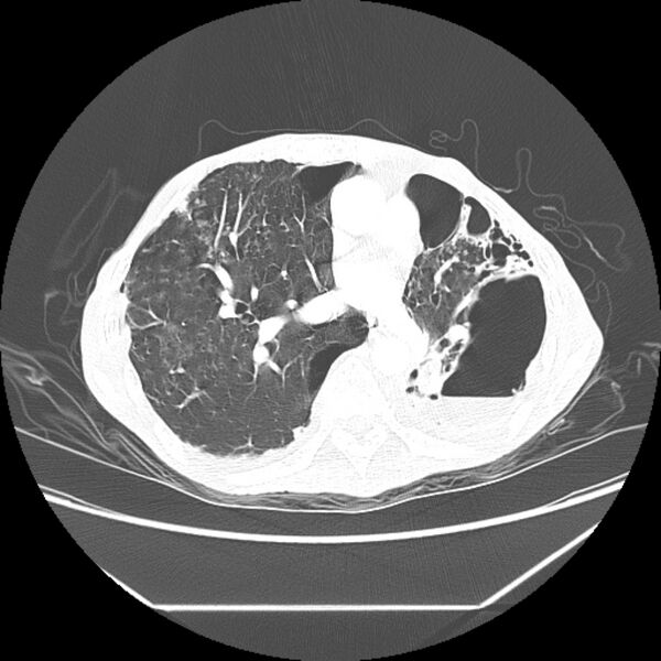 File:Advanced pulmonary tuberculosis (Radiopaedia 8599-9431 Axial lung window 29).jpg