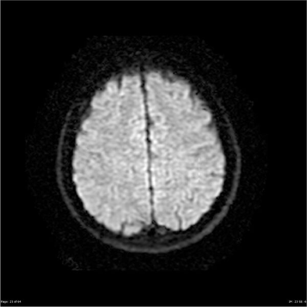File:Amnestic syndrome secondary to hypoxic brain injury (Radiopaedia 24743-25004 DWI 23).jpg