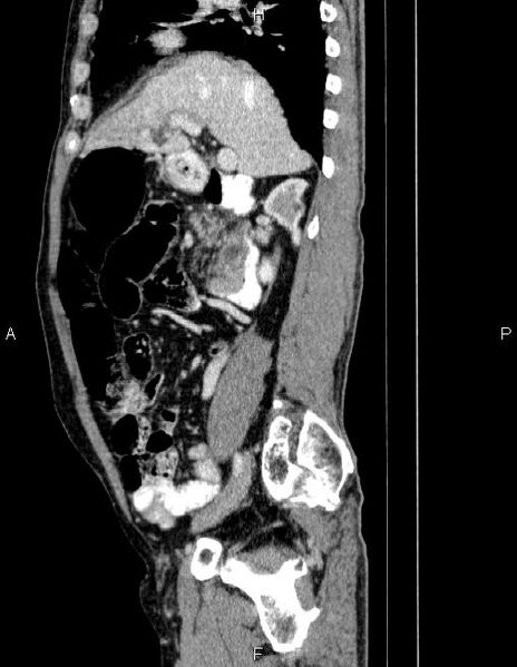 File:Ampullary adenocarcinoma (Radiopaedia 86093-102032 D 34).jpg