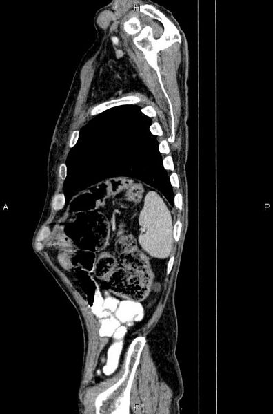 File:Ampullary adenocarcinoma (Radiopaedia 86093-102033 E 81).jpg