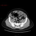 Ampullary carcinoma (Radiopaedia 56396-63056 C 79).jpg