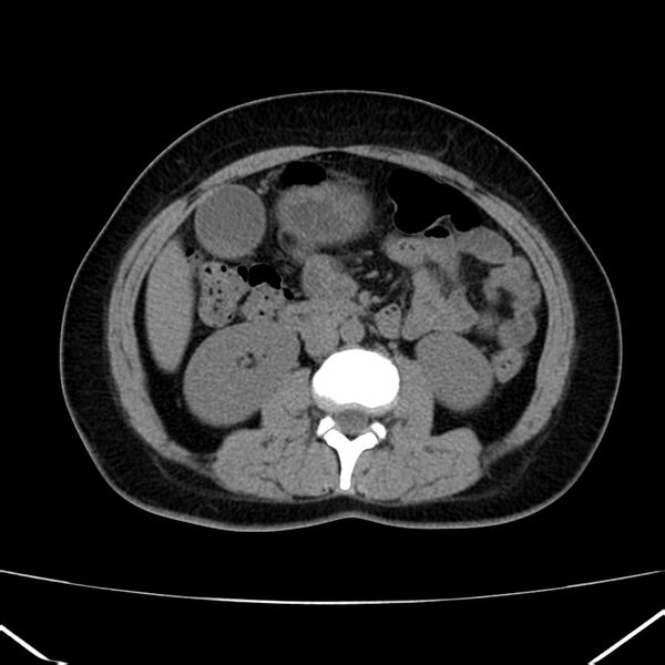 File:Ampullary tumor (Radiopaedia 22787-22816 Axial non-contrast 27).jpg