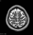 Amyotrophic lateral sclerosis (Radiopaedia 5373-7134 Axial T2 21).jpg