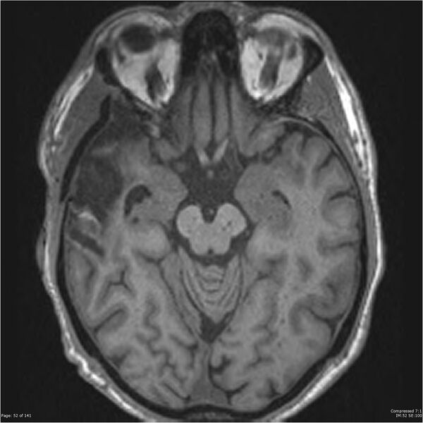 File:Anaplastic meningioma with recurrence (Radiopaedia 34452-35788 Axial T1 50).jpg