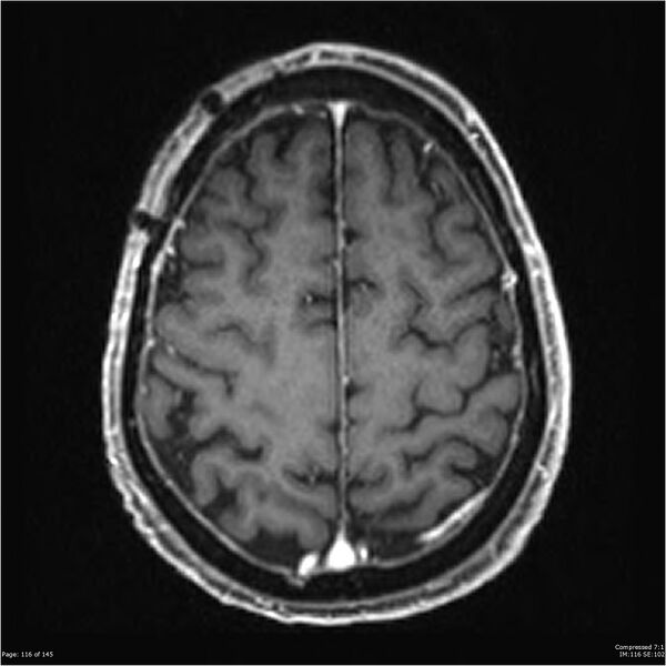 File:Anaplastic meningioma with recurrence (Radiopaedia 34452-35788 Axial T1 C+ 116).jpg