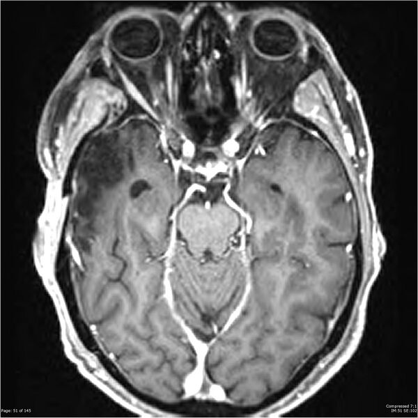 File:Anaplastic meningioma with recurrence (Radiopaedia 34452-35788 Axial T1 C+ 51).jpg