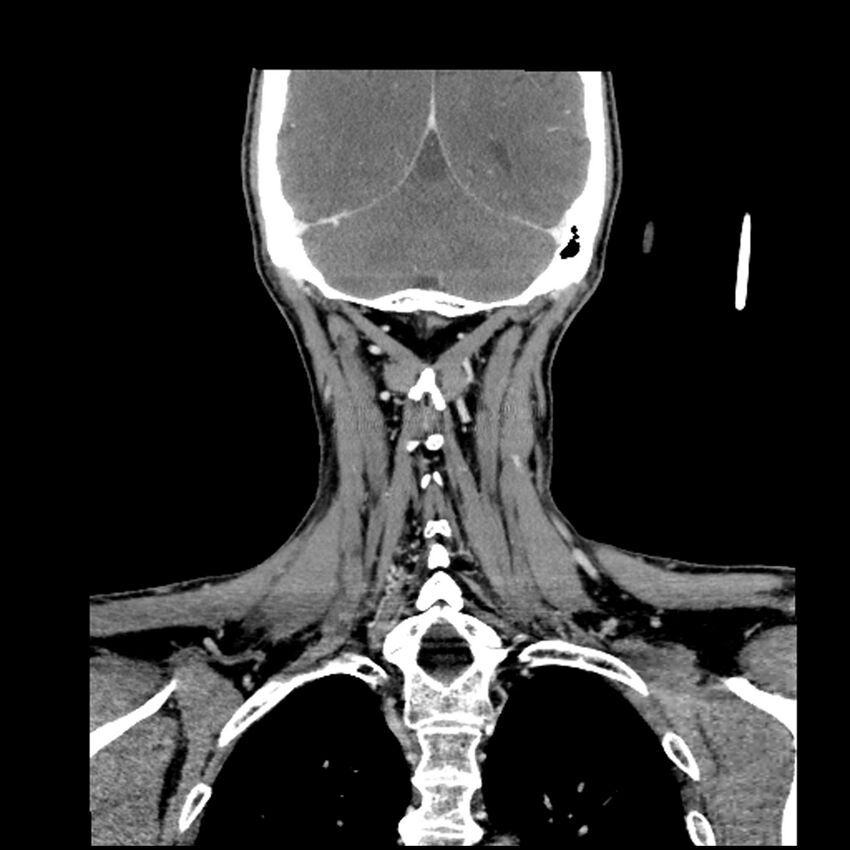 Anaplastic thyroid carcinoma (Radiopaedia 79087-92034 A 92).jpg