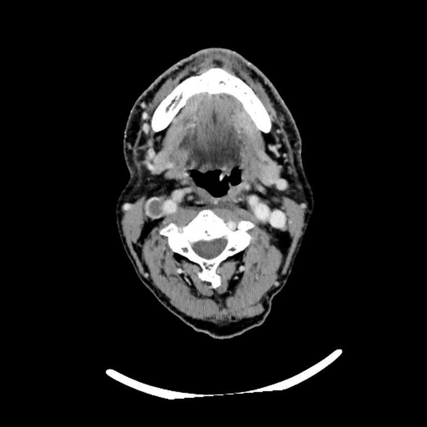 Anaplastic thyroid carcinoma (Radiopaedia 79087-92034 B 81).jpg