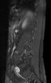 Ankylosing spondylitis - Andersson lesion (Radiopaedia 81878-95838 F 11).jpg