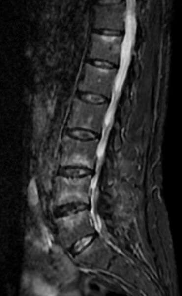 File:Ankylosing spondylitis - Andersson lesion (Radiopaedia 81878-95838 Sagittal STIR 8).jpg