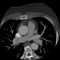 Anomalous origin of left circumflex artery from right coronary sinus (Radiopaedia 72563-83117 A 51).jpg