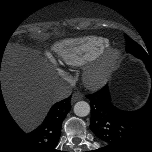 File:Anomalous origin of left circumflex artery from right coronary sinus (Radiopaedia 72563-83117 B 151).jpg