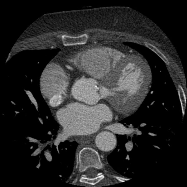File:Anomalous origin of left circumflex artery from right coronary sinus (Radiopaedia 72563-83117 B 63).jpg