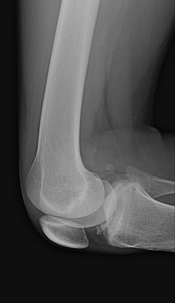 File:Anterior cruciate ligament bony avulsion (Radiopaedia 9241-9925 Lateral 1).JPG