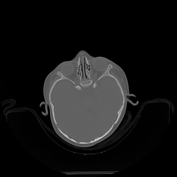 File:Anterior plagiocephaly (Radiopaedia 71836-82273 C 4).jpg