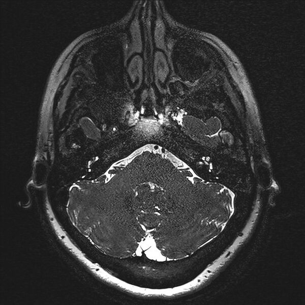 File:Anterior temporal encephalocele (Radiopaedia 82624-96808 Axial T2 high res 5).jpg