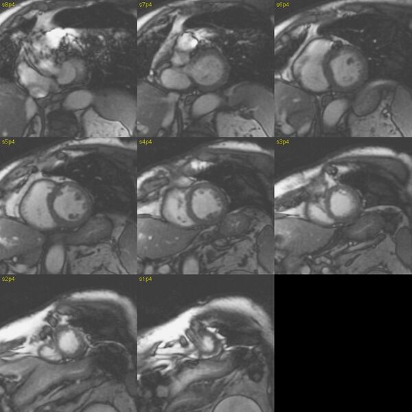 File:Anteroseptal hypokinesia after myocardial infarction (Radiopaedia 15978-15633 E 28).jpg