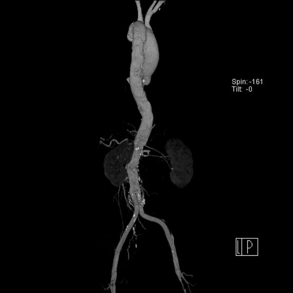 File:Aortic arch saccular aneurysm (Radiopaedia 19430-19457 A 9).jpg