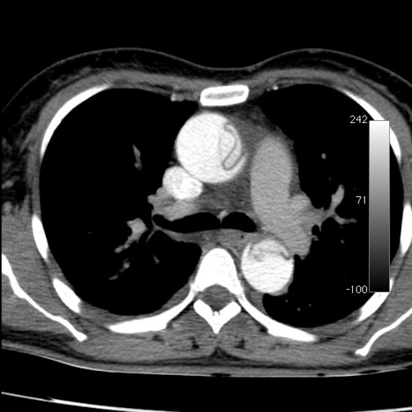 File:Aortic dissection - Stanford type A (Radiopaedia 29247-29659 A 31).jpg