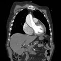 Aortic dissection with rupture into pericardium (Radiopaedia 12384-12647 B 12).jpg