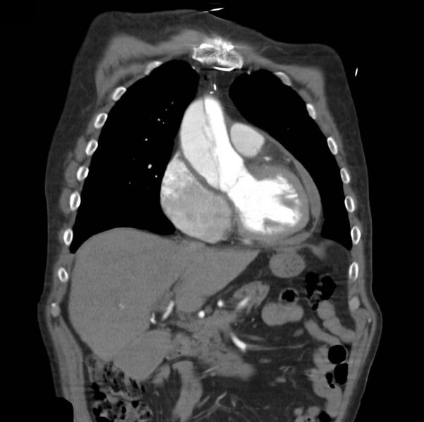 File:Aortic dissection with rupture into pericardium (Radiopaedia 12384-12647 B 12).jpg