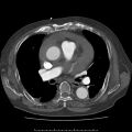 Aortic dissection with rupture into the pericardial sac (Radiopaedia 23726-23879 C+ arterial phase 4).jpg