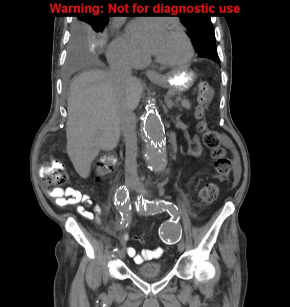 File:Aortic graft infection (Radiopaedia 44979-48907 non-contrast 25).jpg