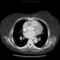Aortic valve stenosis (Radiopaedia 14480-14423 C 4).jpg