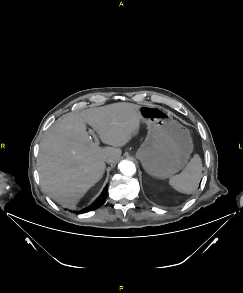 File:Aortoenteric fistula (Radiopaedia 84308-99603 B 50).jpg