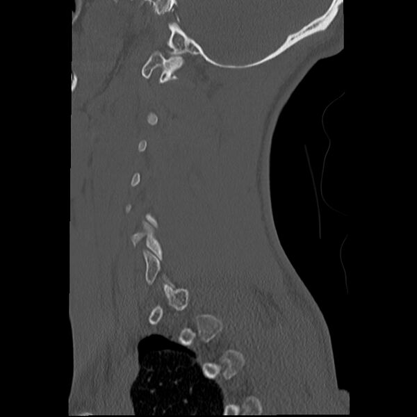 File:Apical pneumothorax on cervical spine CT (Radiopaedia 45343-49368 Sagittal bone window 2).jpg