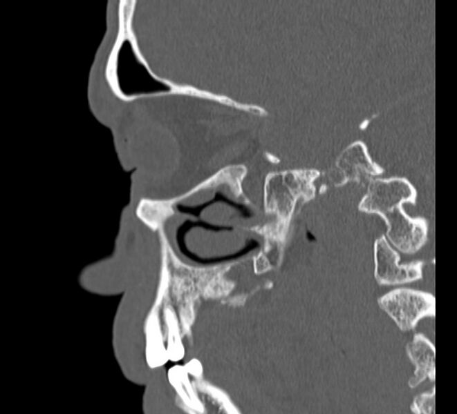 File:Aplastic maxillary sinuses (Radiopaedia 60030-67561 Sagittal bone window 8).jpg